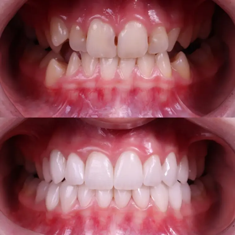 Porcelain veneer before and after — real patient result at ID Dental Implant Center Koreatown