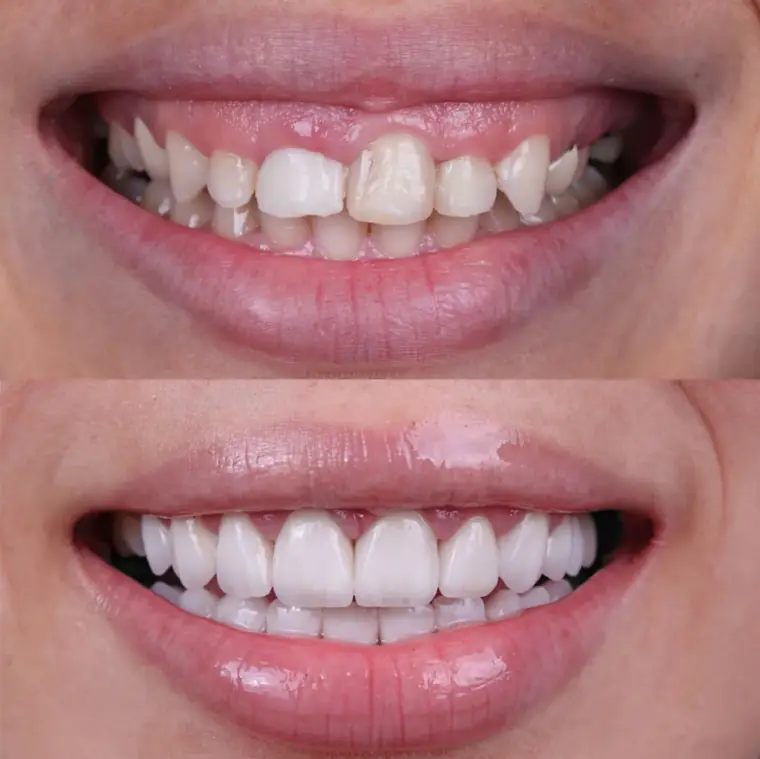 Porcelain veneer before and after — real patient result at ID Dental Implant Center Koreatown