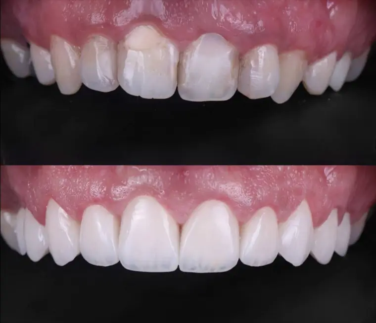 Porcelain veneer before and after — real patient result at ID Dental Implant Center Koreatown