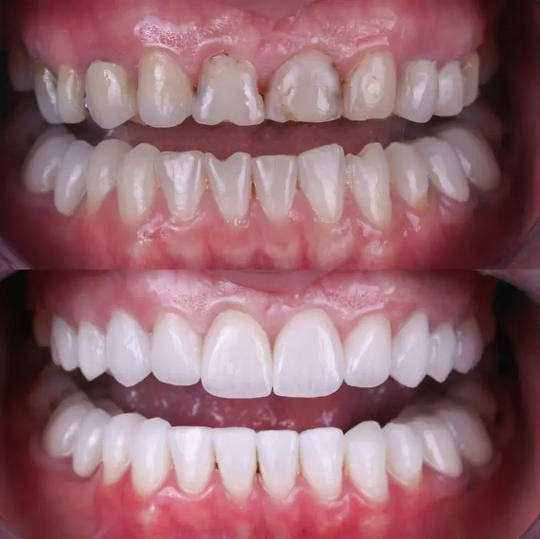 Porcelain veneer before and after — real patient result at ID Dental Implant Center Koreatown