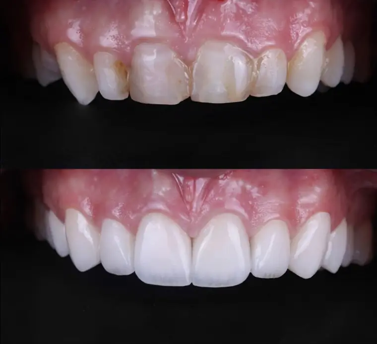 Porcelain veneer before and after — real patient result at ID Dental Implant Center Koreatown