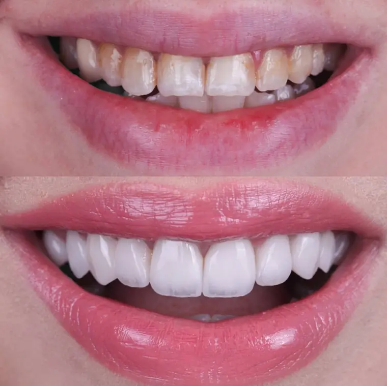 Porcelain veneer before and after — real patient result at ID Dental Implant Center Koreatown